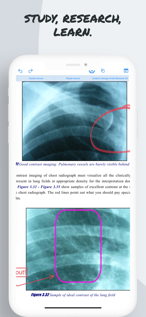 Pencil Notepadアプリで手書きのノートが付いたX線画像を示す医療文書の注釈。