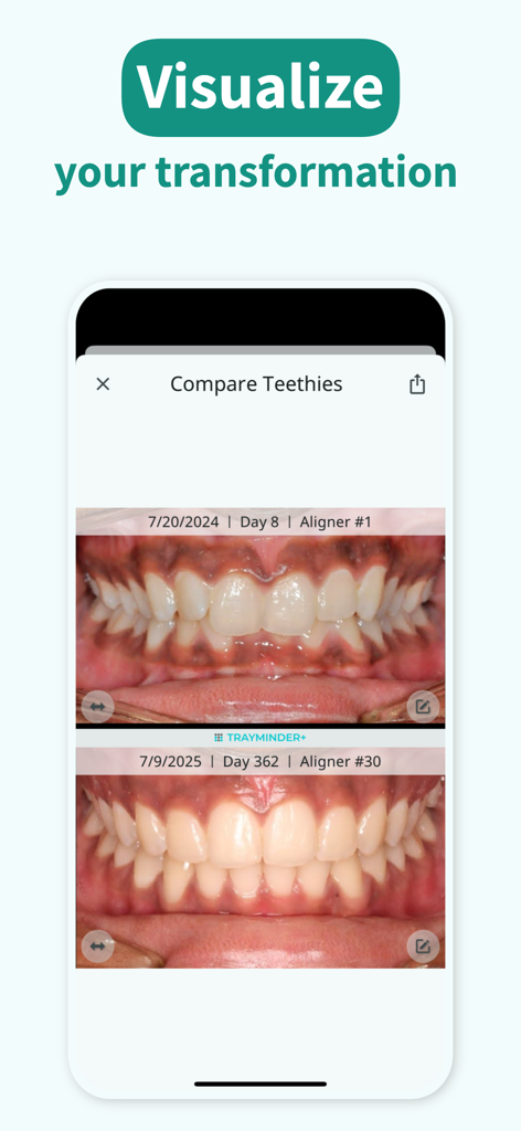 TrayMinder - Comparison of teeth alignment progress over one year in the TrayMinder app