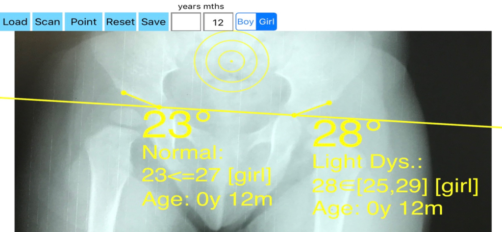 Acetabular Index app interface showing hip dysplasia angle measurements on a pediatric x-ray