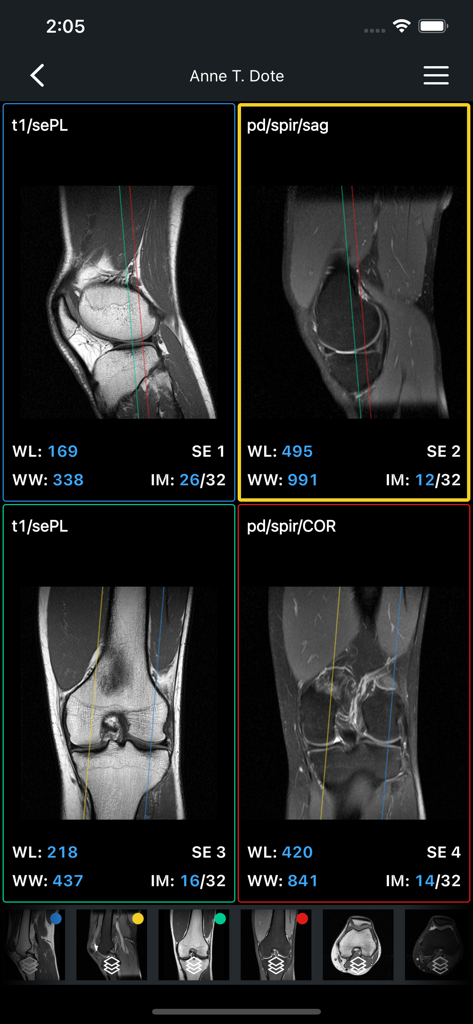 Multi view display of a knee MRI scan in the IMAIOS DICOM Viewer app