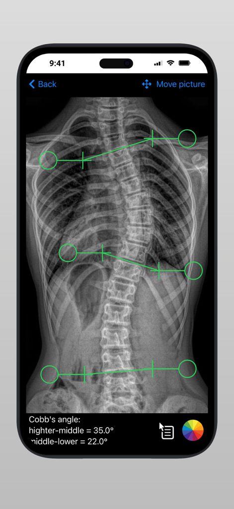 Scodiac2 - Radiografia spinale con misurazioni dell'angolo di Cobb nell'app medica Scodiac2