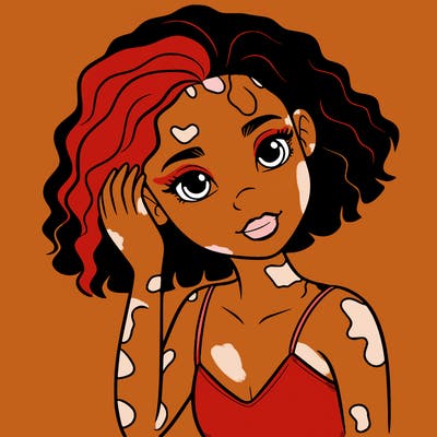 vitiligo black girl