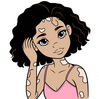 vitiligo black girl