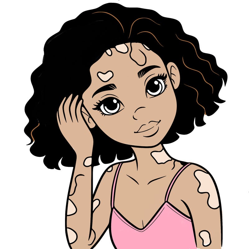 vitiligo black girl