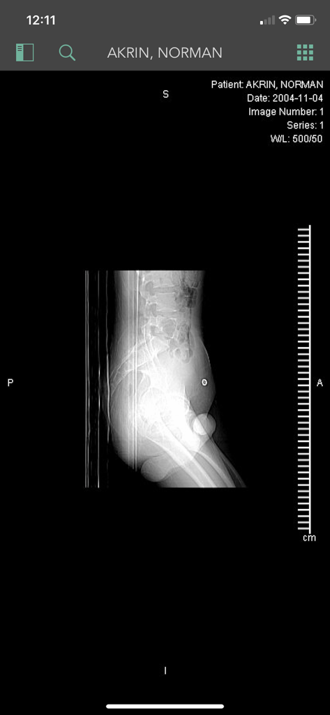 Synapse Mobility (Global) - Side profile medical xray of a patient spine and pelvis being viewed in the Synapse Mobility mobile application.