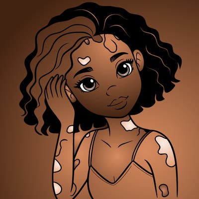 vitiligo black girl
