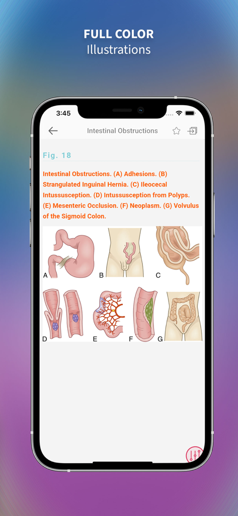 Medical Surgical Nursing Lewis - Anatomical illustrations of intestinal obstructions displayed in the Medical Surgical Nursing Lewis mobile app