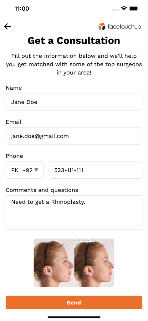 Un modulo di consulenza per la chirurgia plastica all'interno dell'app FaceTouchUp con i risultati simulati di un intervento al naso.