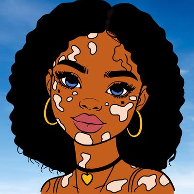 bleautiful black girl with vitiligo