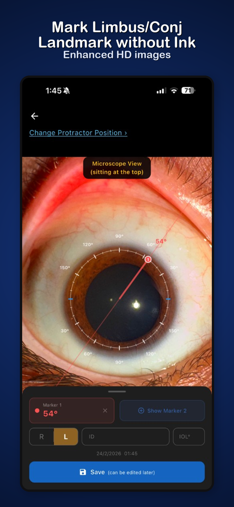 Toric IOL - Toric IOL app screen showing a digital protractor overlay on a close-up eye photo with a 54 degree axis marker