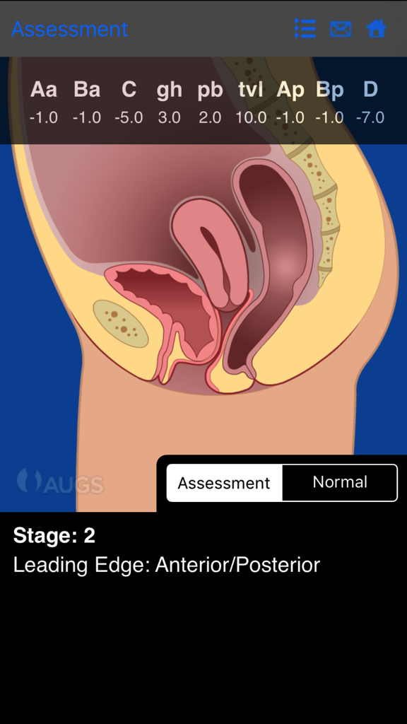 Anatomical cross-section diagram showing Stage 2 pelvic organ prolapse assessment within the AUGS POP-Q mobile app.