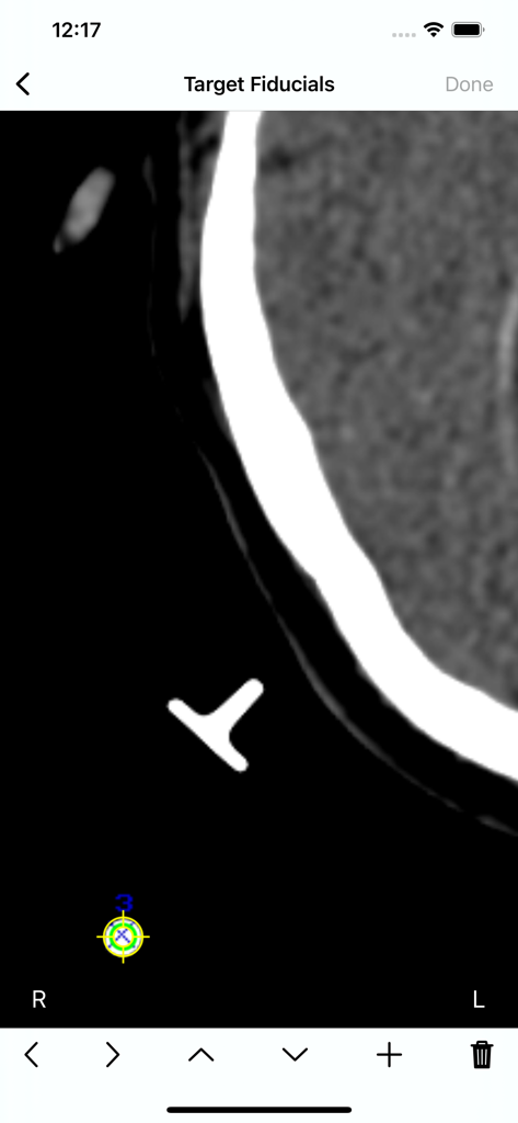 A medical professional marking target fiducials on a neurosurgical scan within the CheckBRW application