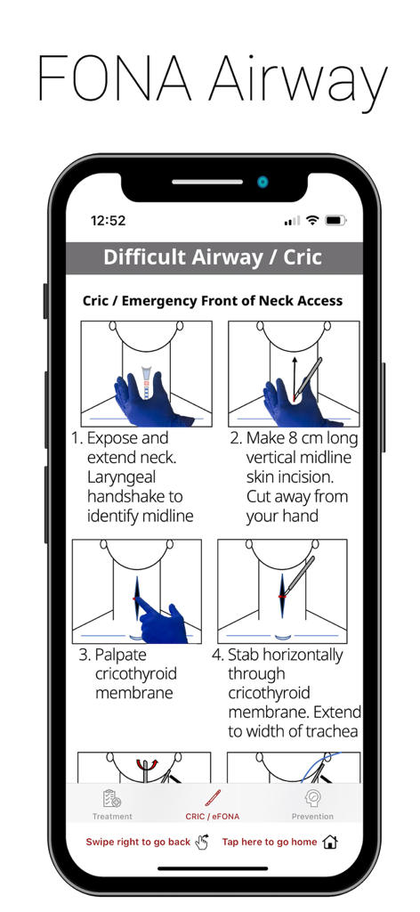 Emergency Manual app screen showing step by step instructions for a cricothyrotomy.