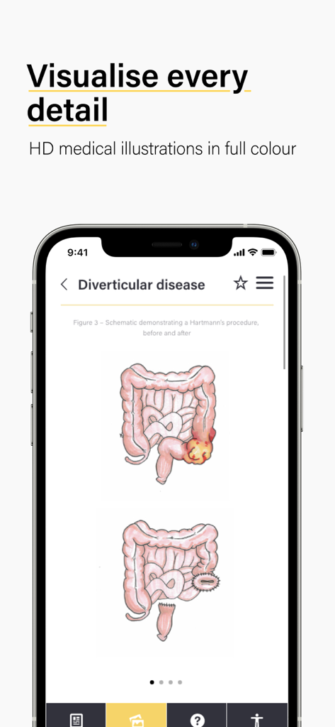 A medical illustration in the Teach Me Surgery app showing before and after stages of a Hartmann's procedure for diverticular disease.