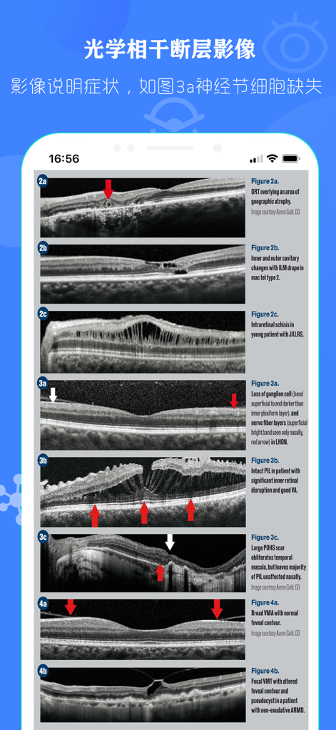 Figuras de escaneo de tomografía de coherencia óptica (OCT) de retina que muestran diversas patologías oculares.