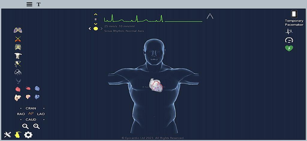 Temporary Cardiac Pacing - Interfaz de la aplicación de Estimulación Cardíaca Temporal que muestra un torso humano 3D con un modelo de corazón y una señal de ECG en vivo