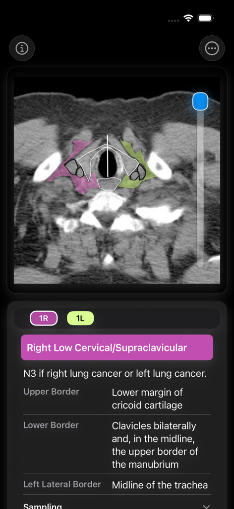 Superposición de TC y definiciones anatómicas para la estación de ganglios linfáticos torácicos 1R