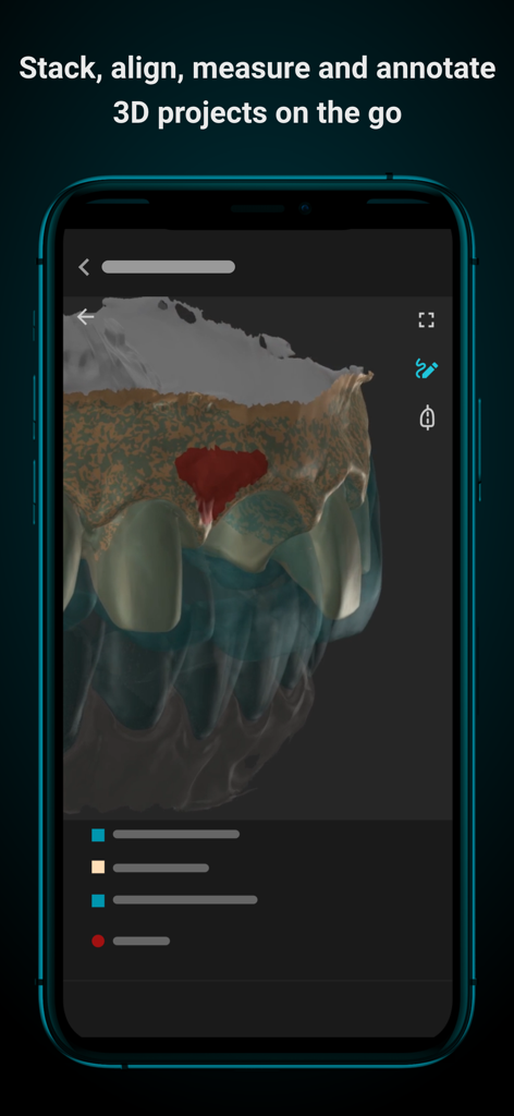 Smilecloud app showing a 3D dental project with annotations on a smartphone