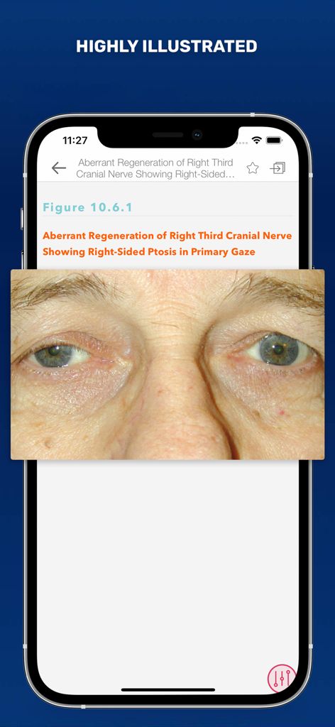 The Wills Eye Manual - Clinical illustration showing right sided ptosis in The Wills Eye Manual app