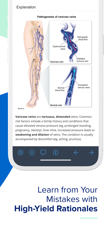 Anatomical diagrams and medical rationale for varicose veins in the UWorld Nursing app interface.