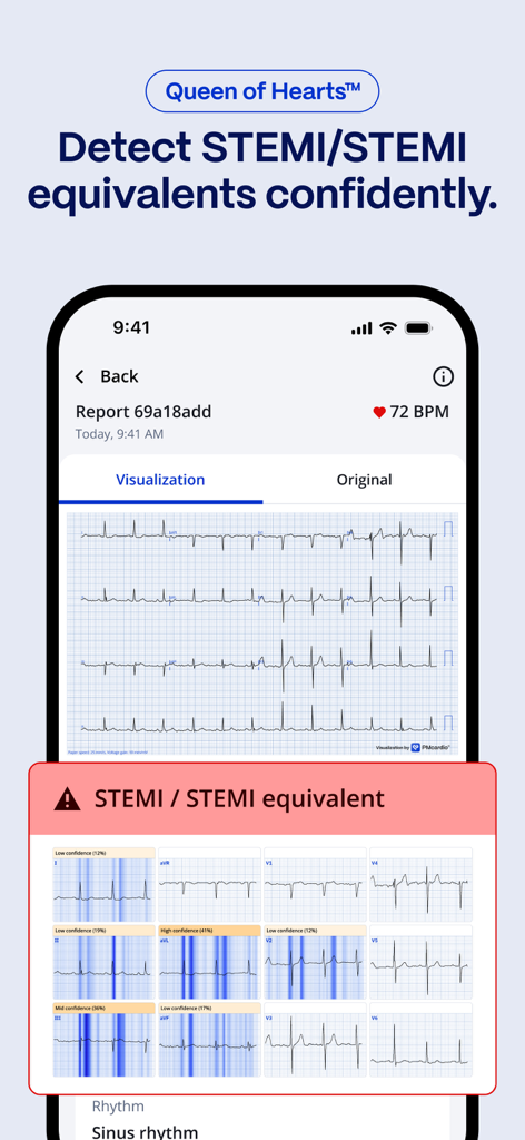 PMcardio app screen showing AI detection of STEMI equivalents with ECG heatmaps