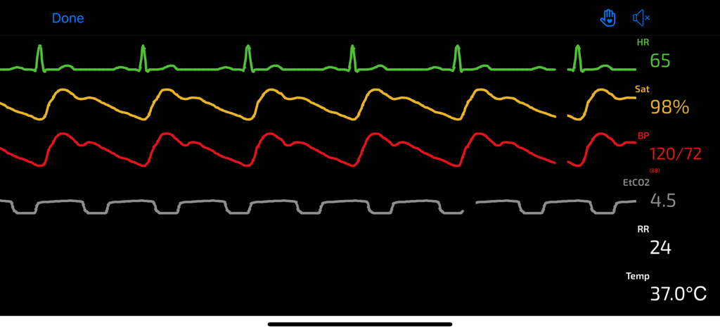 SimMon - SimMon app interface displaying simulated patient vital signs and waveforms