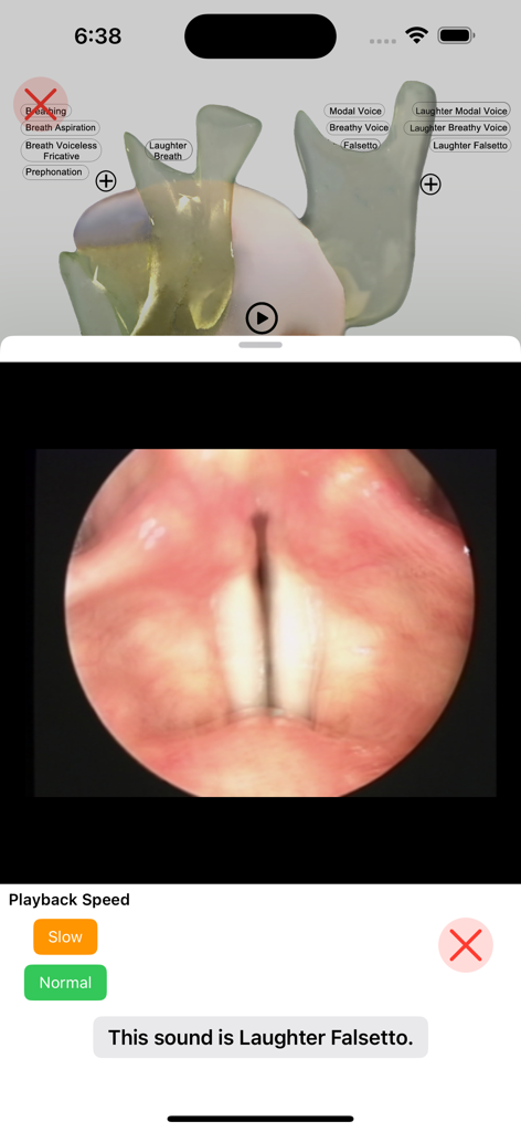 iPA Phonetics - Vidéo laryngoscopique des cordes vocales démontrant l'articulation du rire en fausset.