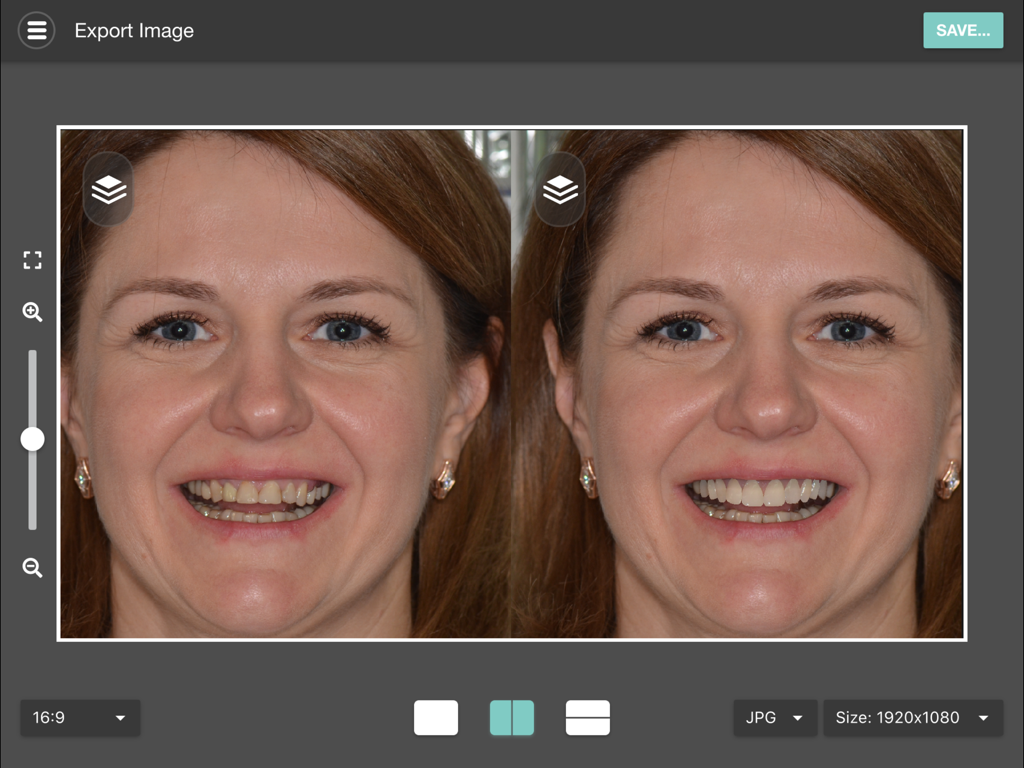 Side by side before and after dental smile makeover simulation within the Smile Designer Pro app interface