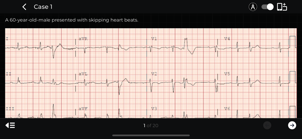ECG Corner - An electrocardiogram tracing for a clinical case study in the ECG Corner app
