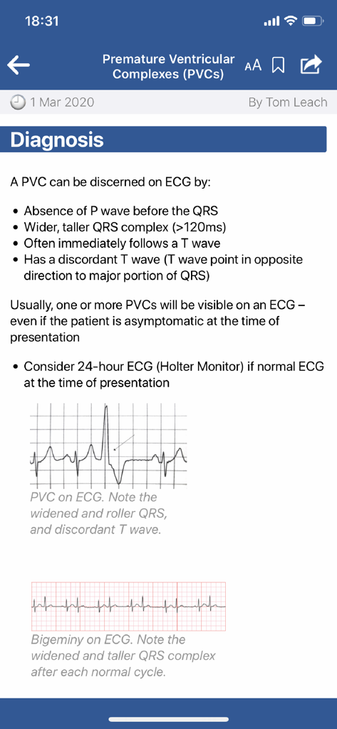 almostadoctor - Medical app screen detailing the diagnosis of Premature Ventricular Complexes with ECG examples.