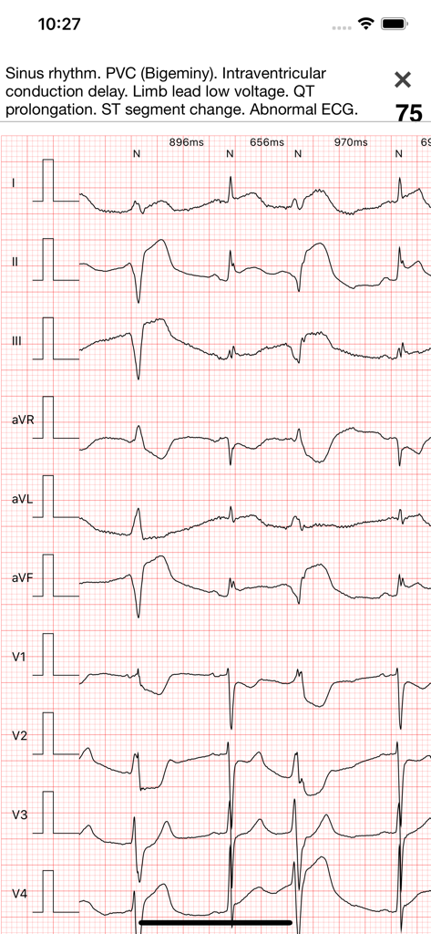 ECG Books Pro - A detailed 12 lead electrocardiogram strip within the ECG Books Pro app showing sinus rhythm and PVC bigeminy