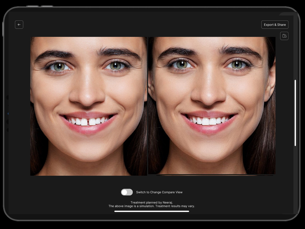 Instant Smiles - Instant Smiles 치과 앱을 사용하여 닫힌 앞니 간격의 디지털 목업을 보여주는 iPad의 측면 비교