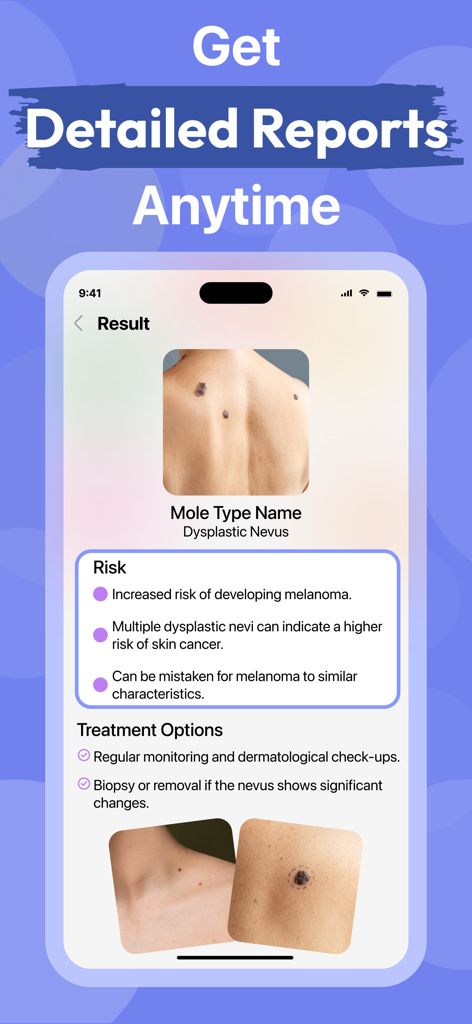 AI Skin Care Scanner・Acne Safe - A detailed AI skin analysis report showing mole identification and risk assessment.