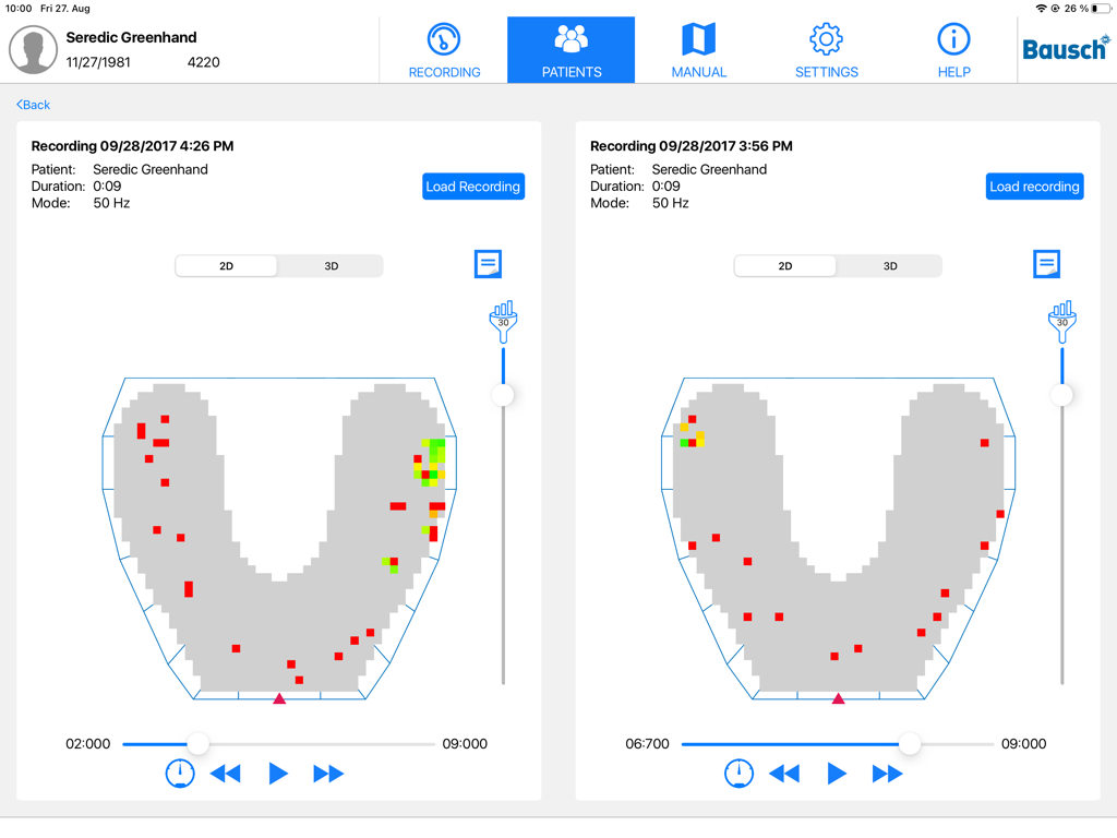 OccluSense - Side by side comparison of dental bite pressure recordings on the OccluSense app interface