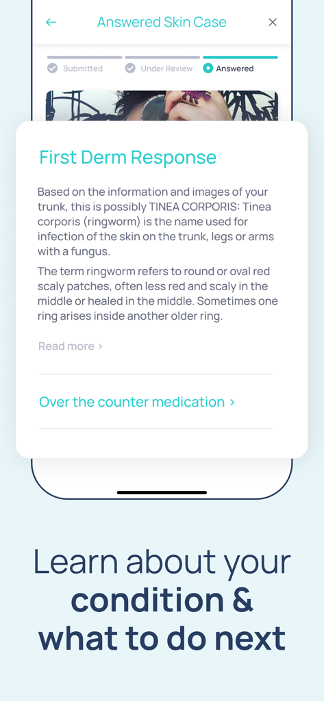 Dermatology First Derm - First Derm mobile app interface displaying a professional dermatologist response for a ringworm skin condition assessment