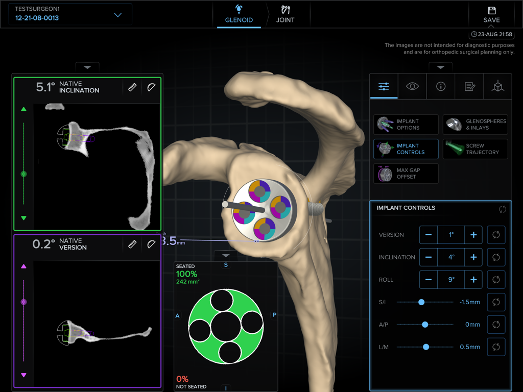ArthrexVIP - ArthrexVIP interface displaying 3D glenoid implant positioning and surgical controls