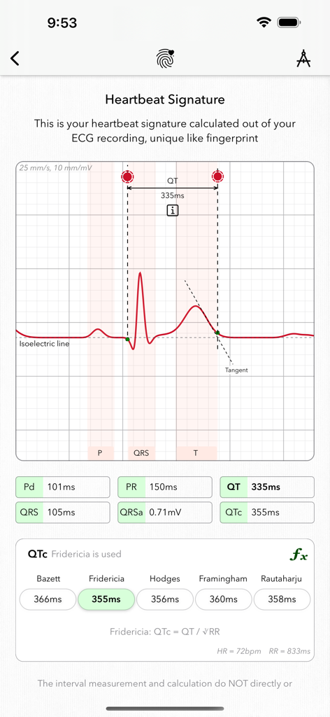 ECG+ | Your Watch ECG Reader - Detailed ECG waveform analysis showing heartbeat signature and PQRST intervals