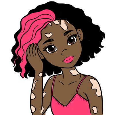 vitiligo black girl