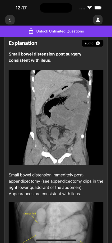A medical education screen from the Basic Radiology app showing a CT scan and detailed explanation for small bowel distension