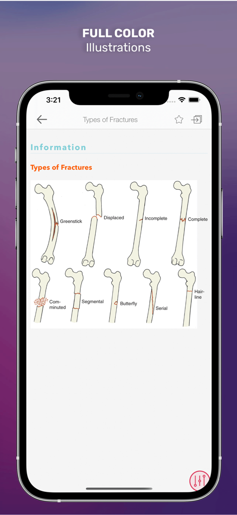 OB/GYN Peds Notes - Ilustraciones a todo color que muestran varios tipos de fracturas óseas como en tallo verde y conminutas en la aplicación médica OB/GYN Peds Notes.
