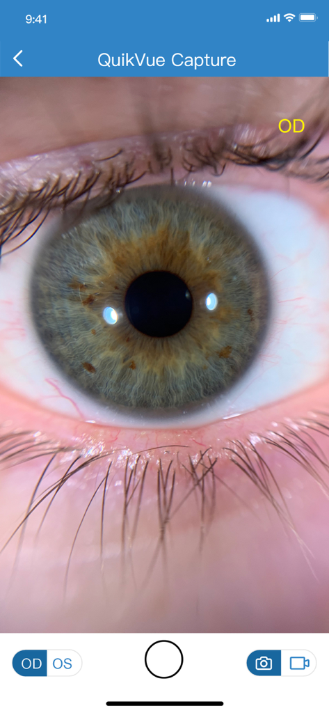 VisuDoc - High definition close up image of a patient iris displayed on the VisuDoc app interface using the QuikVue capture tool