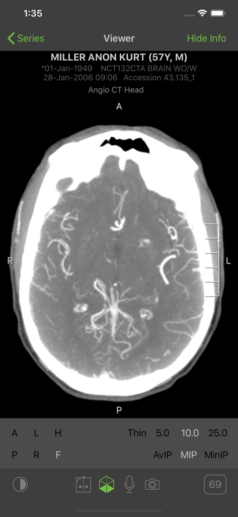 Visage Ease - A medical professional viewing an Angio CT head scan on the Visage Ease mobile application interface.