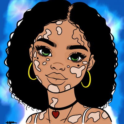 bleautiful black girl with vitiligo