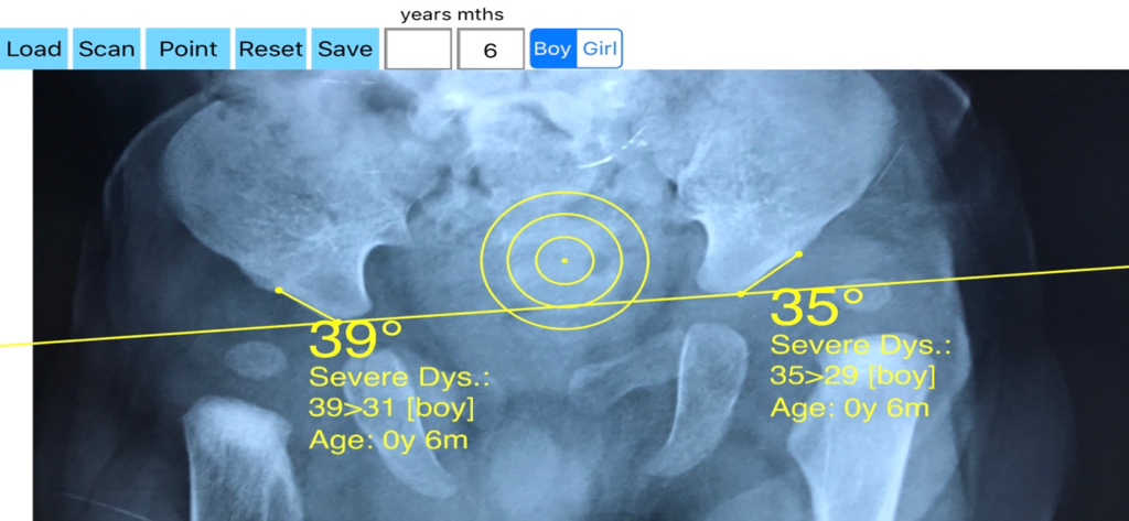 Medical app interface for acetabular index measurement on a pelvic X-ray indicating severe hip dysplasia