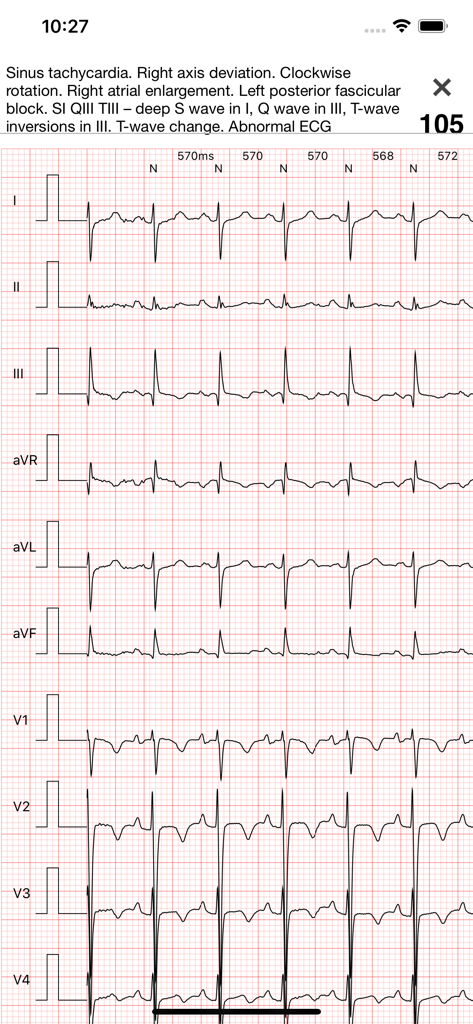 ECG Books Pro - A detailed 12 lead ECG report on a grid background showing sinus tachycardia and other cardiac abnormalities.