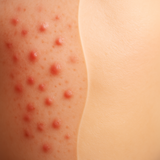 AcneTrack – Your Acne Journey