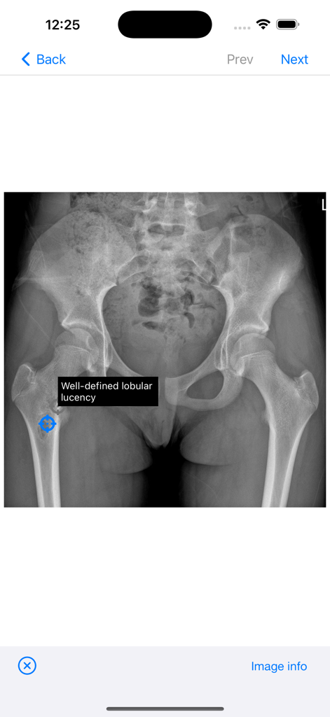 BoSTT - Pelvic xray with a well defined lobular lucency highlighted in the femur on the BoSTT app