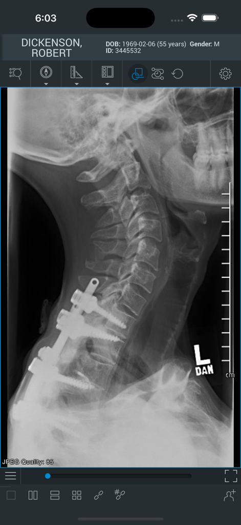 ResolutionMD - ResolutionMD app interface displaying a medical X-ray of a cervical spine with surgical hardware