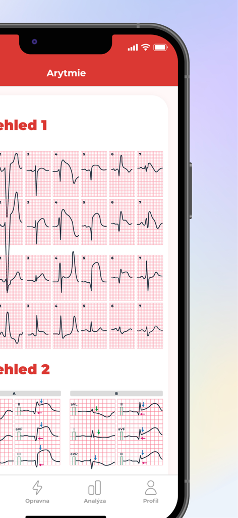 Pantalla de aplicación móvil que muestra varias formas de onda de EKG para el análisis de arritmias médicas