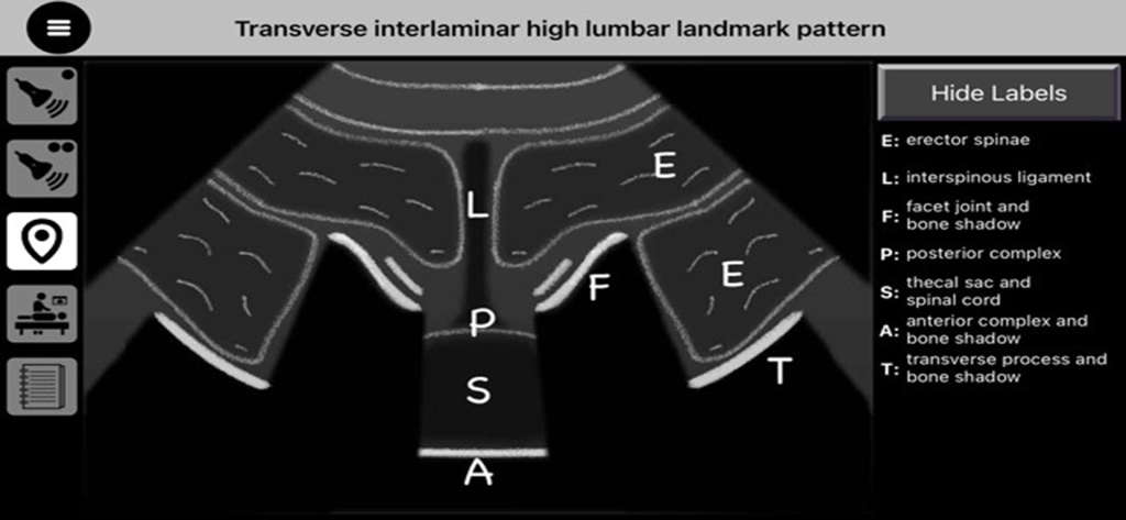 AnSo Pro - Diagrama de padrão de marco lombar alto interlaminar transverso com rótulos anatômicos no aplicativo AnSo Pro.